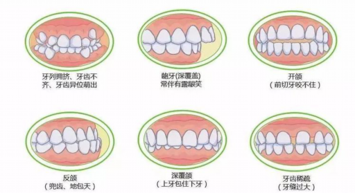 矫正牙齿戴导板有什么_矫正牙齿戴导板有什么作用(图1)